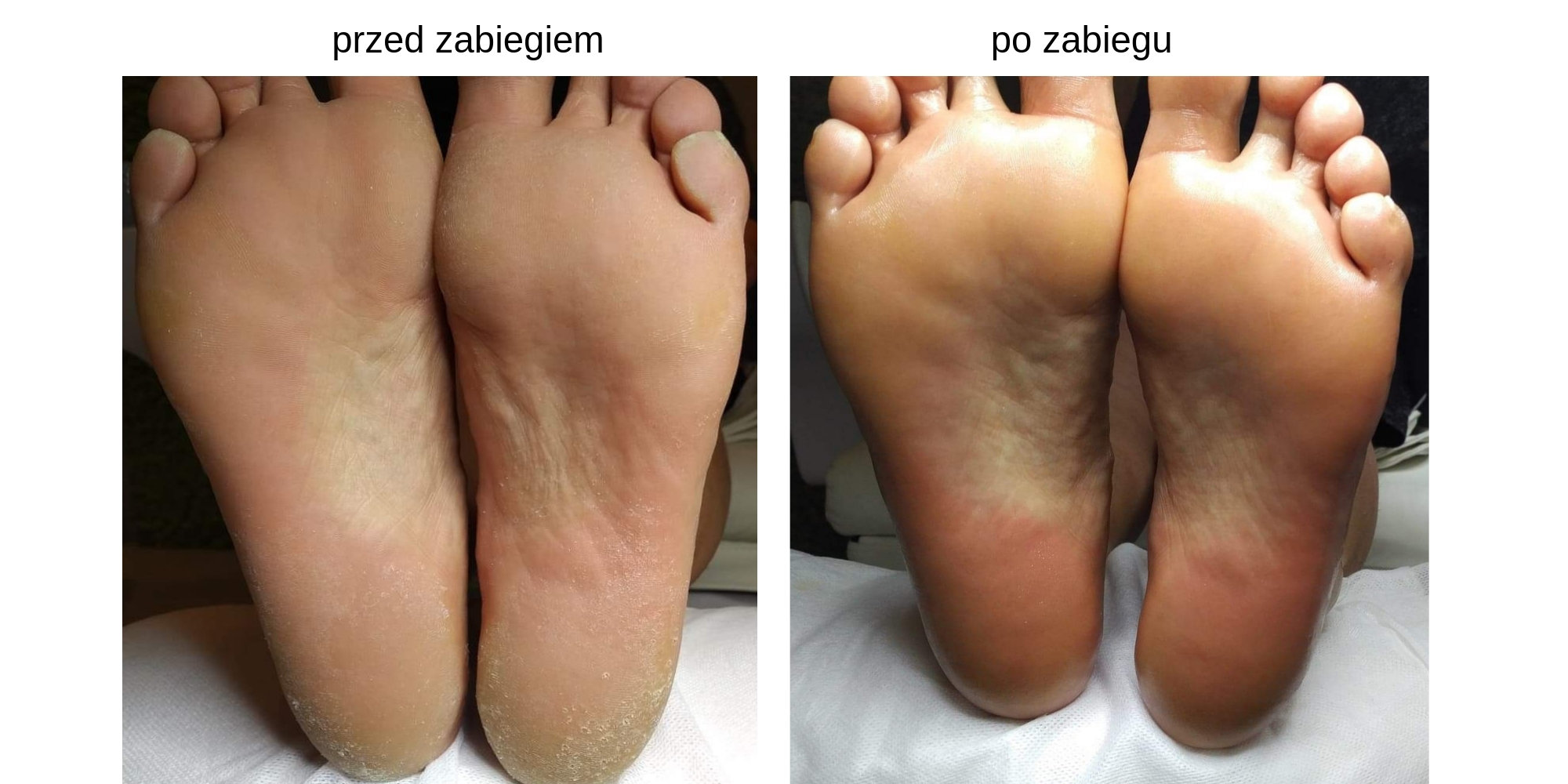 pedicure podologiczny